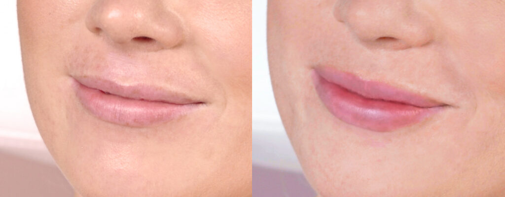before and after restylane kysse
