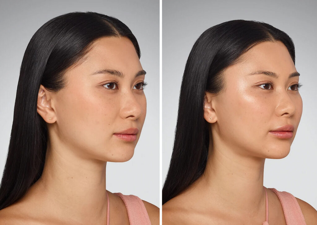juvederm before and after